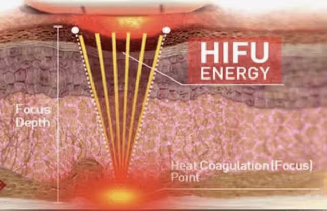 hifu_vaginal hifu_vaginal